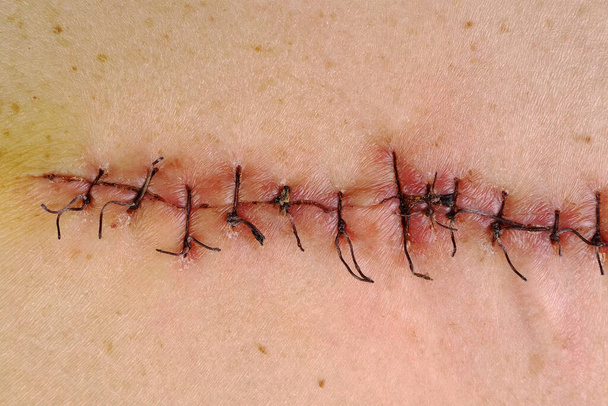 Suturas médicas, puntos después de la cirugía, suturas quirúrgicas cosidas en el cuerpo humano. Atención médica quirúrgica. Primer plano. - Foto, imagen
