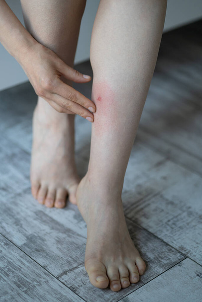 Kobieta dotyka nogi po ugryzieniu przez komara lub pchłę w hotelu, cierpi na reakcję alergiczną i obrzęk, odczuwa ból. Reakcja skórna na wysysające krew owady. Alergia.  - Zdjęcie, obraz