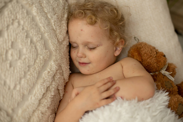 Little toddler girl with chickenpox in bed, playing at home, quarantine isolation during sickness, Varicella zoster virus or Chickenpox bubble rash - Photo, Image