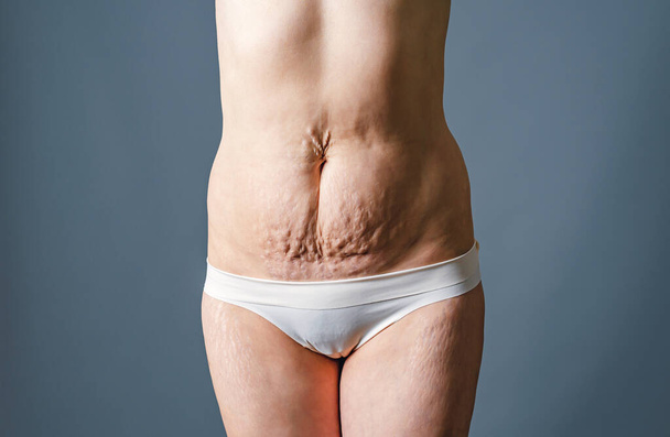 Front view of skin of woman with stretch marks and flabby skin after childbirth. Naked belly and thighs of woman. Skin and body care. - Photo, Image