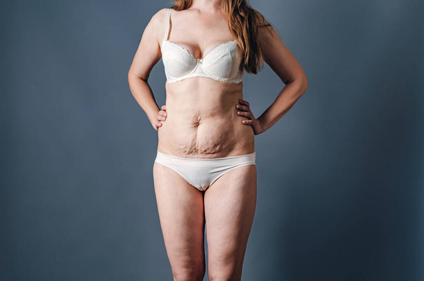 Female body in white lingerie after childbirth. Stretch marks on women's skin. Postpartum depression - Foto, afbeelding