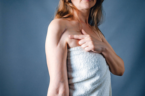 Mujer vista lateral en toalla muestra la cicatriz del dedo en la mano después de la cirugía. Tratamiento de cicatrices. Pulido láser - Foto, Imagen