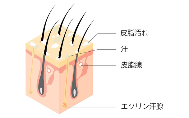 Diagrammatic illustration of a cross section of a dirty scalp, isometric - Translation: dirty scalp - Vector, Image