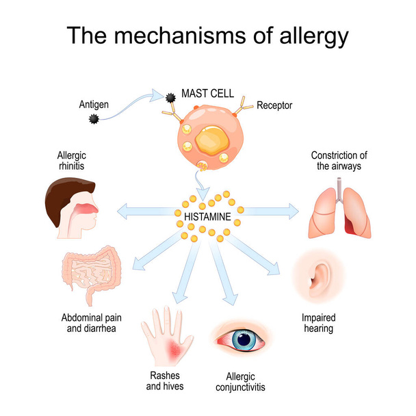Механизм аллергии. Тучные клетки и аллергическая реакция. Гистамин. местная иммунная реакция. векторная иллюстрация - Вектор,изображение