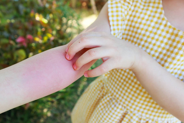 女の子持っています皮膚発疹アレルギーとかゆみオン彼女の腕 - 写真・画像