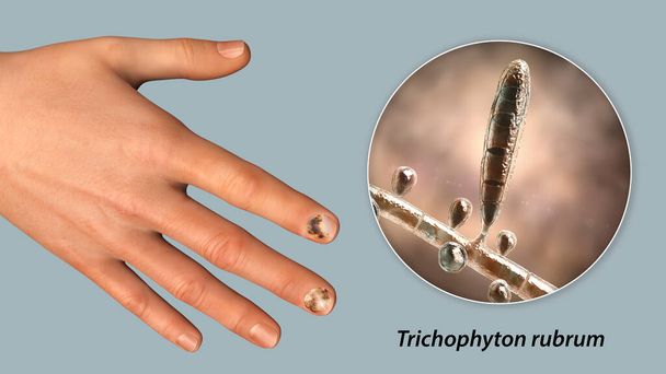 Human hand with onychomycosis and close-up view of Trichopyton rubrum fungi, one of the causative agents of nail infections, 3D illustration - Photo, Image