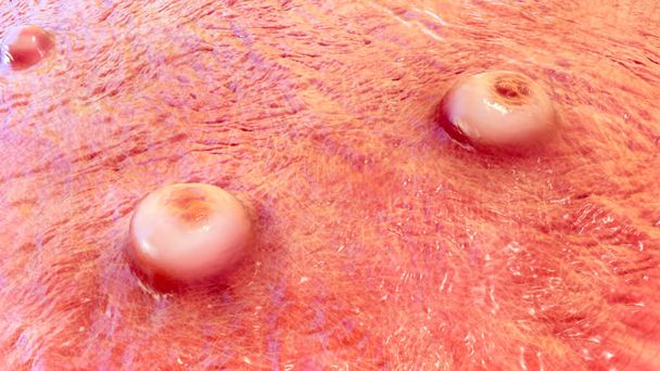 Lésions cutanées de la variole du singe, de la variole, de Molluscum contagiosum et d'autres infections par le virus Poxviridae, illustration 3D - Photo, image