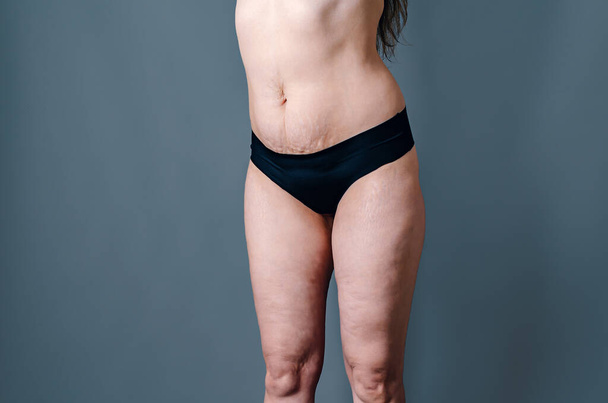 Вид спереди на кожу женщины с растяжками и дряблой кожей после родов. Naked belly and thighs of woman. Уход за кожей и телом. - Фото, изображение