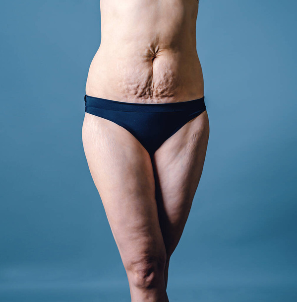 Front view of skin of woman with stretch marks and flabby skin after childbirth. Naked belly and thighs of woman. Skin and body care. - Zdjęcie, obraz