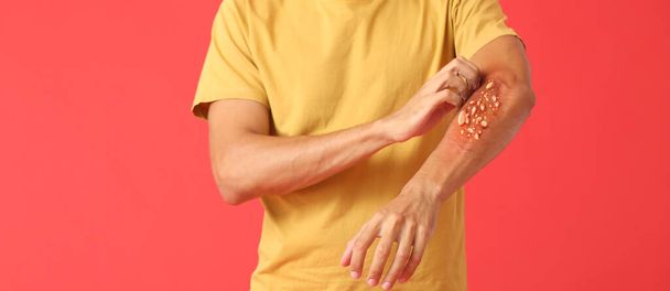 Homme malade de la variole du singe se gratter le bras sur fond rouge - Photo, image