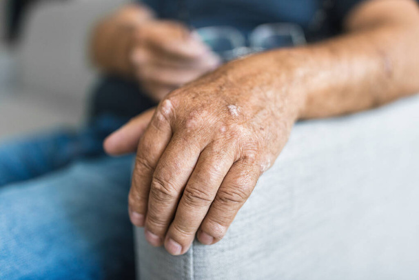Elderly man suffering from psoriasis, closeup on hands - Foto, imagen