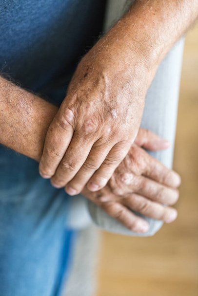 Elderly man suffering from psoriasis, closeup on hands - 写真・画像