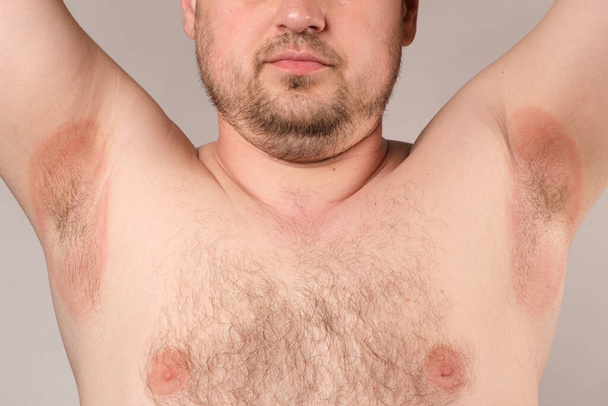 Enrojecimiento de las axilas en un hombre: inflamación o calor espinoso, manchas rojas de las axilas - Foto, Imagen