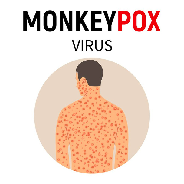 Monkeypox-Virus. Ein Mann mit Affenpocken und Ausschlag am ganzen Körper. Krankheitssymptome. Virusinfektion. Vektorillustration. - Vektor, Bild