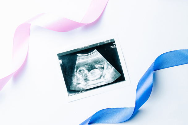 Zdjęcie dziecka w ciąży z USG. Niebieska, różowa wstążka z ultradźwiękowym zdjęciem ciąży na białym tle. Pojęcie ciąży, macierzyństwa, oczekiwania na poród dziecka - Zdjęcie, obraz