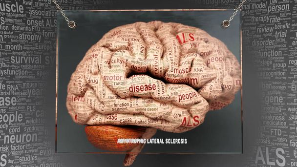 Esclerosis lateral amiotrófica en el cerebro humano - docenas de términos que describen sus propiedades pintadas sobre la corteza cerebral para simbolizar su conexión con la mente. - Foto, imagen
