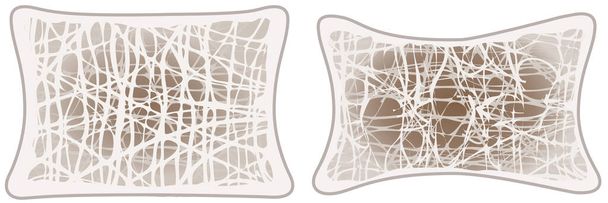 Illustration zeigt Osteoporose, normale Wirbel und osteoporotische Wirbel. Beschriebene Illustration - Foto, Bild