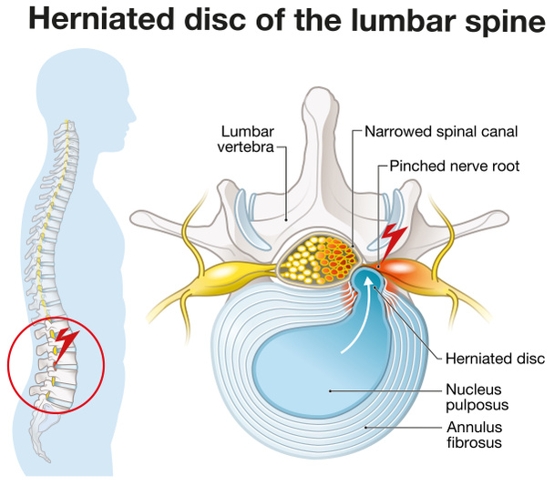 Illustration showing lumbar vertebra with intervertebral disc and herniated nucleus pulposus - Photo, Image