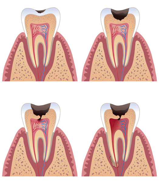 Caries stages - Vector, Image