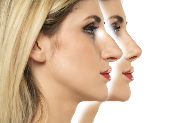 Junge Frau vor und nach der Schönheitsoperation der Nase auf weißem Hintergrund. - Foto, Bild