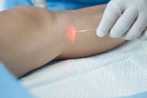 Lähikuva kuva laserkuitu kädessä lääkäri lateksi käsine - Valokuva, kuva