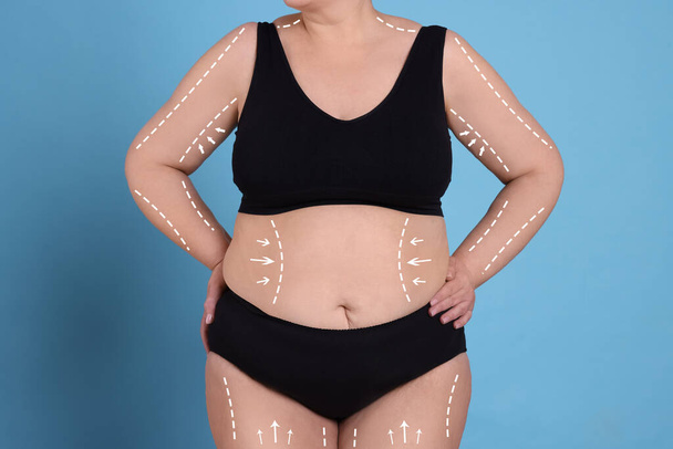 Woman with marks on body before cosmetic surgery operation on light blue background, closeup - Photo, image