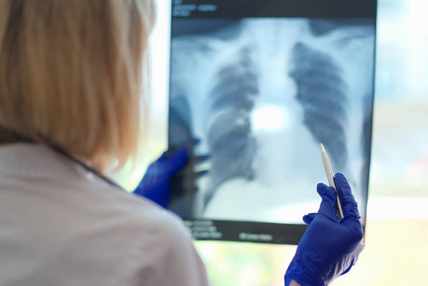 Close-up of radiologist looking at damaged area on lung x ray. Pulmonologist making diagnostic for patient. Medicine and planned checkup concept - Foto, Imagen