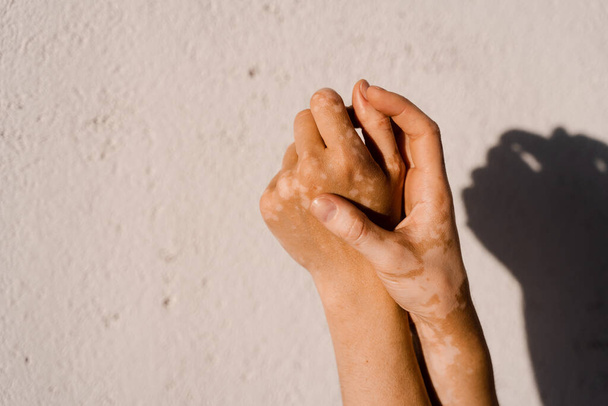 Vitiligo Hautpigmentierung an den Händen der Frau. Saisonale Hauterkrankungen - Foto, Bild