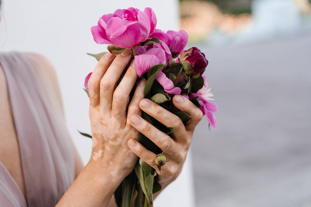 Руки з пігментацією шкіри вітіліго та букетом з півоній квітів. Сезонні захворювання шкіри
 - Фото, зображення
