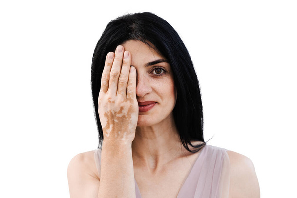 Mujer georgiana con manchas de pigmentación vitiligo en las manos cubre su cara con las manos. Estilo de vida con enfermedades estacionales de la piel - Foto, Imagen