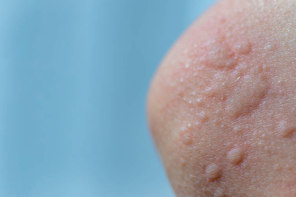 Urticária na pele. Manchas vermelhas de uma reação alérgica na pele de uma criança. Sintomas de urticária de perto. - Foto, Imagem