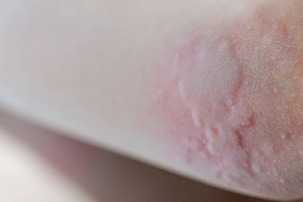 Urticaria en la piel. Manchas rojas de una reacción alérgica en la piel de un niño. Síntomas de urticaria de cerca. - Foto, Imagen