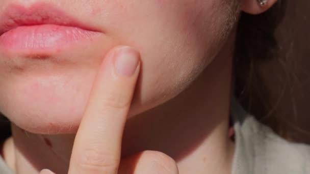 Een vrouw die acne op haar gezicht aanraakt. Huidgezondheidsirritatie door het dragen van een masker. Problematische huid bij een jonge vrouw. Probleem van puistjes en puistjes op de gezichtshuid.  - Video