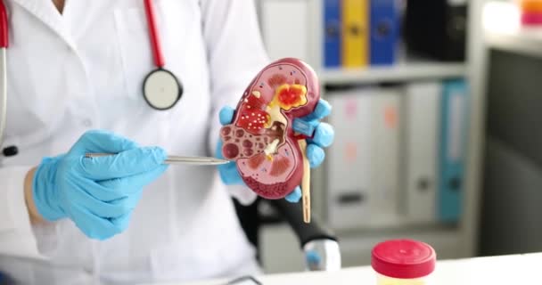 Surgery of kidneys and adrenal glands is medical surgical intervention. Doctor holds kidney anatomy model in hand - Footage, Video
