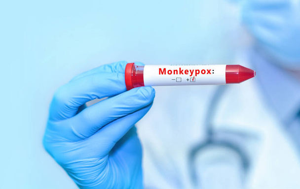 Médico segurando um tubo de amostra de sangue teste com vírus da varíola macaco positivo (MPXV) - Foto, Imagem