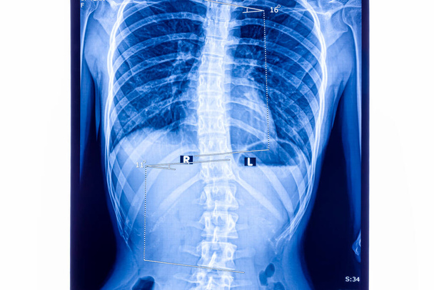 X ray showing scoliosis of the lumbar spine. Scoliosis is an abnormal lateral curvature of the spine.  - Photo, Image