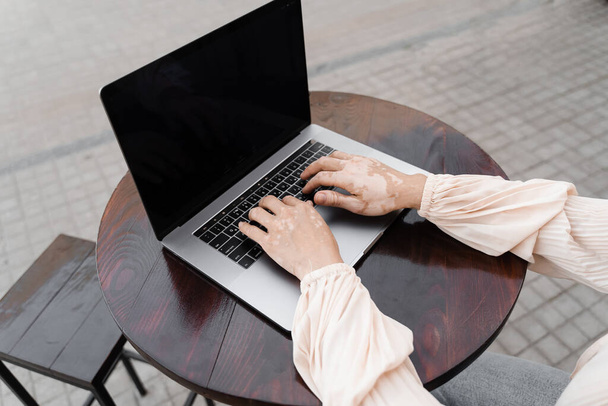 Девушка с пигментацией кожи витилиго на руках печатает на ноутбуке онлайн крупным планом. Сезонные заболевания кожи - Фото, изображение