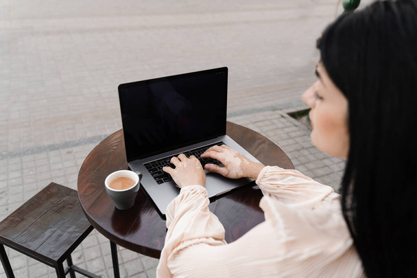 Woman typing text on laptop. Hands with vitiligo pigmentation seasonal skin disease. Working online. Lifestyle with vitiligo - Photo, Image