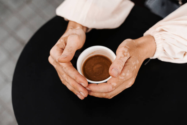 Manos con pigmentación de la piel de vitiligo sosteniendo la taza de café sobre fondo negro de cerca. Estilo de vida con enfermedades estacionales de la piel - Foto, Imagen