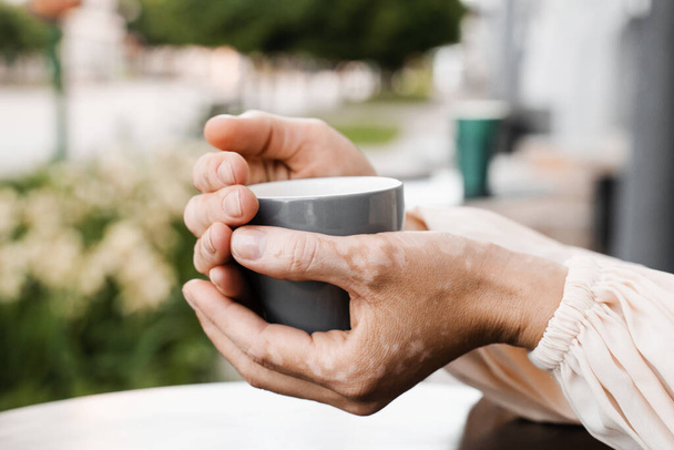 Руки з пігментацією шкіри вітіліго тримають чашку кави крупним планом. Стиль життя з сезонними захворюваннями шкіри
 - Фото, зображення