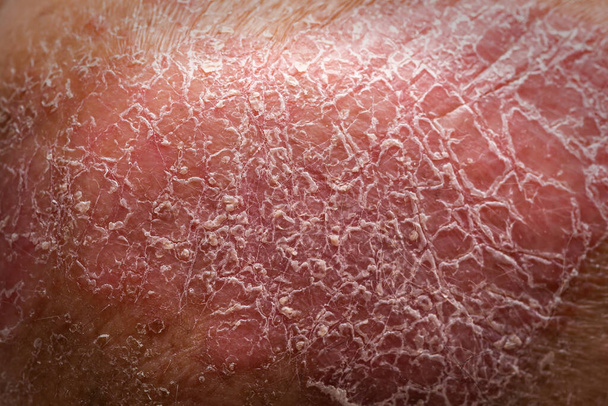 Extrême CU Tir, peau avec psoriasis sur le coude - Photo, image