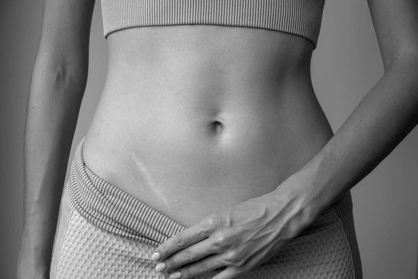 A black and white photo of an appendicitis scar on a young athletic woman - Foto, afbeelding
