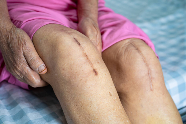 Asiática senior o anciana anciana mujer paciente mostrar sus cicatrices cirugía total rodilla reemplazo articular sutura herida cirugía artroplastia en cama en enfermería hospital sala, saludable fuerte concepto médico. - Foto, imagen
