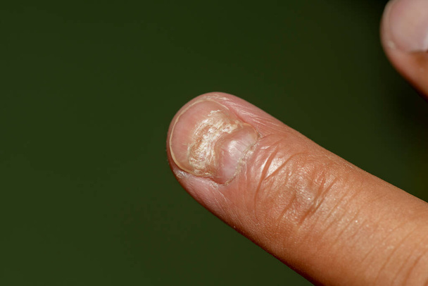 Close-up Fungal fingernails isolated on the white background.Macro view single finger nail damaged by infection soft focus.  - 写真・画像