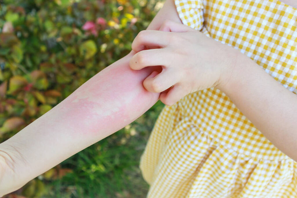 Klein meisje heeft huiduitslag allergie en jeuk aan haar arm - Foto, afbeelding