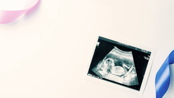 Ultrasound photo pregnancy baby. Blue, pink ribbon with ultrasound pregnancy picture on white background. Concept maternity, pregnancy, childbirth - Fotografie, Obrázek
