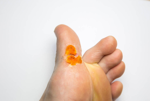 Malattia contagiosa della pelle a piedi. Foto trattamento medico - Foto, immagini