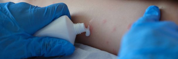 Lékař v rukavici nanáší krém na kůži pacienta se zarudlými záněty. Hmyzí kousnutí a pojetí dětské kožní alergie - Fotografie, Obrázek