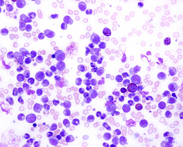 Chronic myeloid leukaemia. Light micrograph of a blood smear from a patient with chronic myeloid or granulocytic leukaemia. This is a cancer of the bone marrow, in which the granulocyte precursors, or myeloblasts, fill up the bone marrow. - Photo, Image