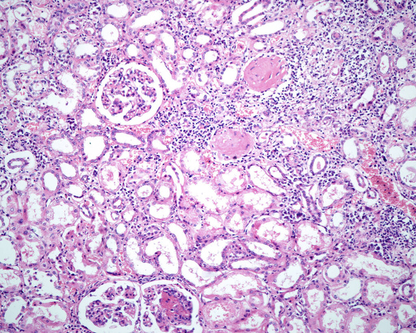 Polyarteritis nodosa (PAN) είναι μια συστηματική νεκρωτική φλεγμονή των αιμοφόρων αγγείων (αγγειίτιδα) που περιλαμβάνει συνήθως τις αρτηρίες των νεφρών και άλλων εσωτερικών οργάνων. Μικροσκόπιο φωτός που δείχνει κατεστραμμένα αιμοφόρα αγγεία με τμηματική ινώδη - Φωτογραφία, εικόνα